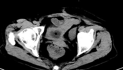 Spontaneous Rupture of Urinary Bladder: Two Case Reports and Review of Literature